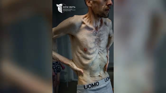 Ukraine công bố ảnh tù binh 'da bọc xương' khi được Nga trao trả