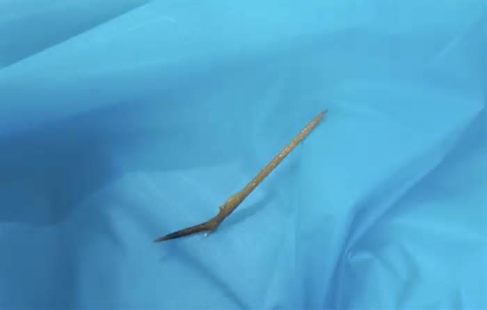 Nuốt tăm xỉa răng, người đàn ông suýt thủng tá tràng