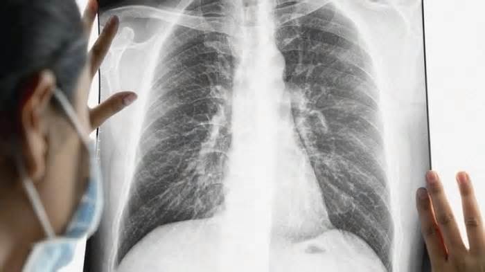 Lý do nhiều người không hút thuốc vẫn bị ung thư phổi