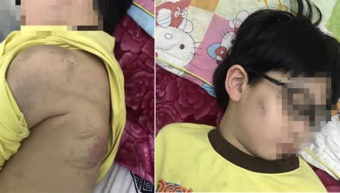 Cháu bé 8 tuổi ở Quảng Ninh bị mẹ bạo hành phải nhập viện