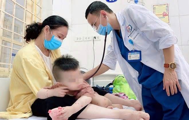 Gần 80 ca mắc tay chân miệng tại Hà Nội chỉ trong vòng 1 tuần