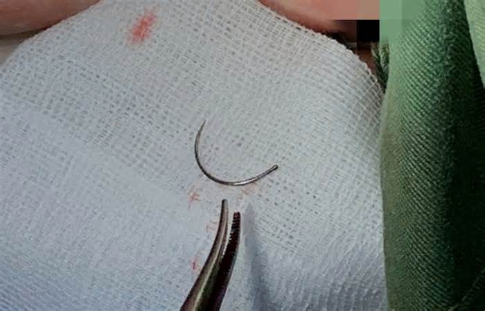 Lấy dị vật kim khâu nằm trong tầng sinh môn nữ bệnh nhân sau 11 năm