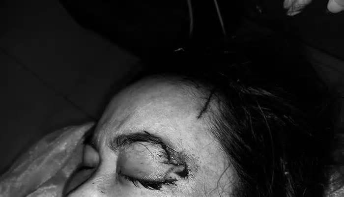 Thêm 1 tai nạn chó cắn: Người phụ nữ 40 tuổi bị chó cắn rách kết mạc mắt, đứt lệ quản