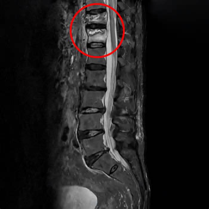 Thoát cảnh liệt giường nhờ bơm xi măng sinh học khôi phục 2 đốt sống vỡ, xẹp