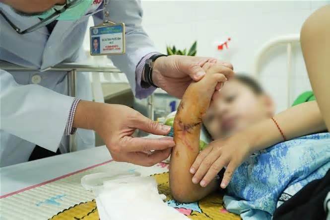 TP Hồ Chí Minh: Nối thành công bàn tay bị đứt lìa cho bé trai 5 tuổi