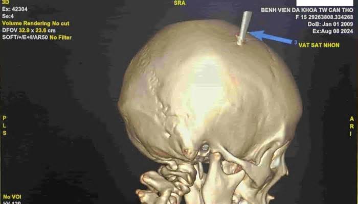 Chơi đùa với em trai, bé gái bị kéo xuyên sọ