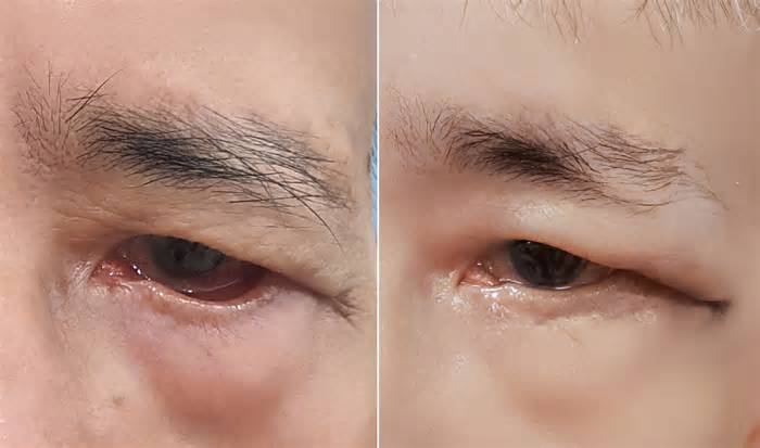Phẫu thuật tạo hình bờ mi sau 10 năm liệt dây thần kinh số 7