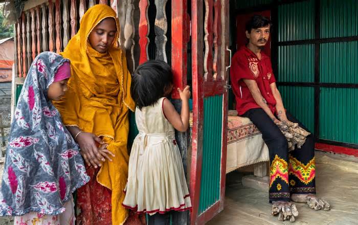 Người cây Bangladesh: 'Án chung thân' trong 'nhà tù cơ thể'