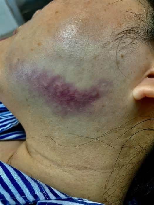 Nữ công chứng viên ở Quảng Ninh bị nhổ bọt, đá sưng mặt lần đầu lên tiếng