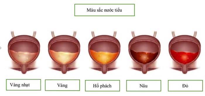 Tự 'bắt bệnh' qua màu sắc, mùi nước tiểu