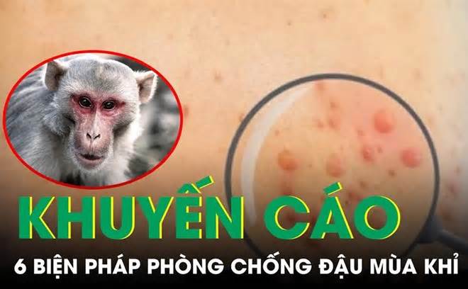 Kiên Giang ghi nhận 3 trường hợp mắc đậu mùa khỉ, 1 tử vong do HIV