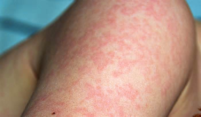 Người lớn mắc rubella có trở nặng không?