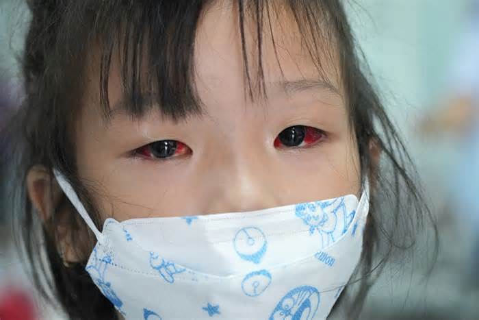 Nhiều trẻ có đôi mắt đỏ ngầu đi khám bệnh