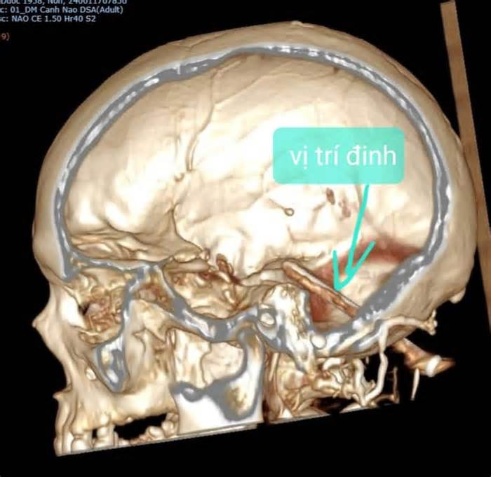 Hy hữu: Người đàn ông bị đinh 7cm đâm vào não gần 1 năm mới phát hiện