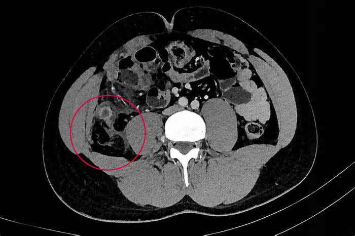 Ruột thừa hoại tử