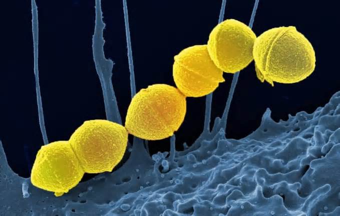 Bệnh do vi khuẩn 'ăn thịt người' lây lan ở Nhật Bản nguy hiểm thế nào