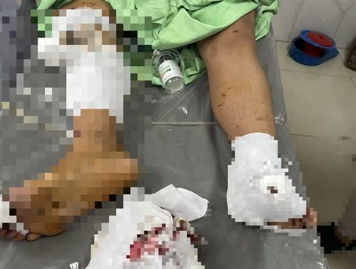 Bé trai 12 tuổi ở Đắk Lắk bị thương nặng, dập nát 2 bàn tay do pháo nổ