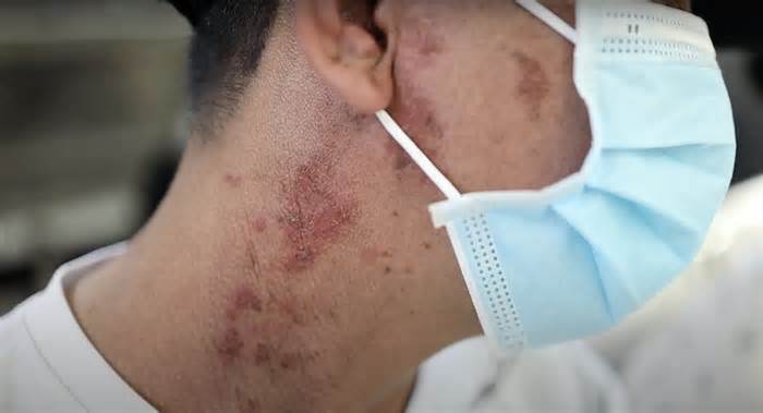 Nhiều người TP HCM bội nhiễm da do độc của kiến ba khoang