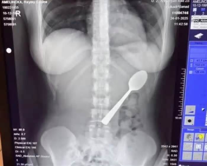 Vô tình nuốt phải thìa dài 17 cm khi đang ăn sữa chua