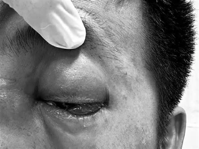 Suýt mù mắt do nhiễm trùng ở vùng 'tam giác tử thần'