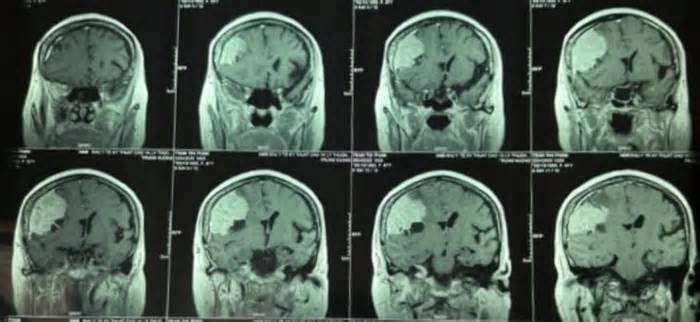 Đi khám đau đầu, phát hiện khối u màng não to hơn trứng vịt