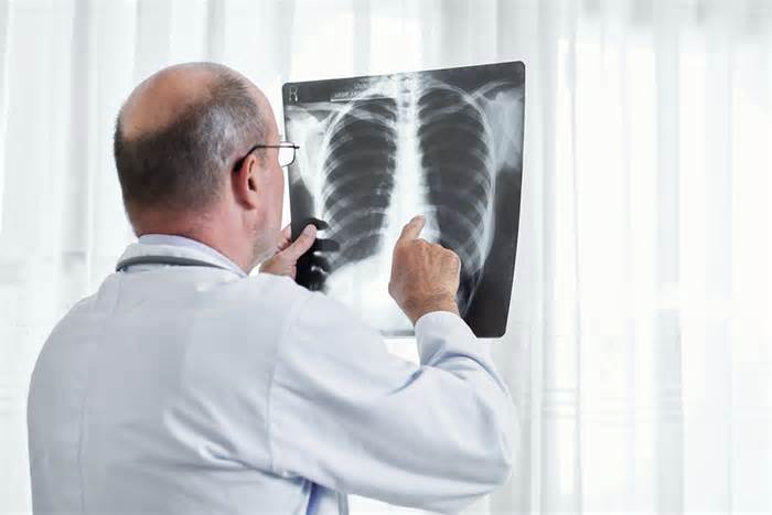 Thuốc mới của Anh tăng cơ hội sống bệnh nhân ung thư phổi lên 84%