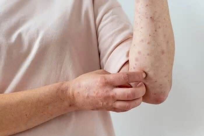 Ghi nhận 78 ca nghi mắc sởi và rubella, Bộ Y tế chỉ đạo nóng