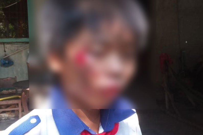 Công an vào cuộc làm rõ vụ một học sinh lớp 6 ở Tiền Giang bị thương